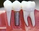 Имплантация зубов в Октябрьском